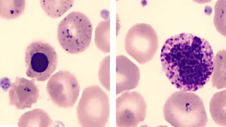 Metal Toxicity for the USMLE Step 2