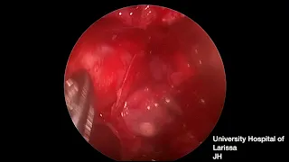 endoscopic orbital decompression