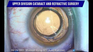 Intraocular lens exchange after YAG capsulotomy w/placement of Vivity lens inside the capsular bag