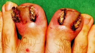 Most Popular Ingrown Toenails