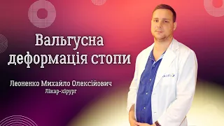 Вальгусна деформація стопи