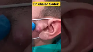 Cyst Pop Compilation #cystremoval #shorts Dr khaled sadek