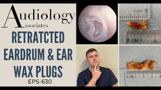 RETRACTED EARDRUM & EAR WAX PLUGS - EP630