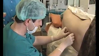 Продленная Эпидуральная Анестезия при кесаревом сечении (видео)
