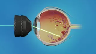 Medication Injection and Laser Surgery for Macular Edema