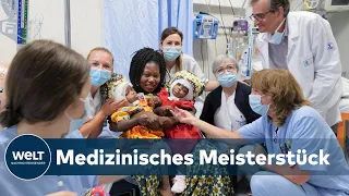 SIAMESISCHE ZWILLINGE GETRENNT: Hochkomplexe Operation ermöglicht medizinisches Wunder