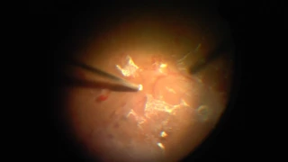 27 Gauge Vitrectomy in Complicated Proliferative Diabetic Retinopathy Surgery