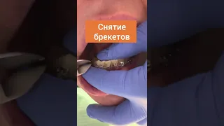 Снятие брекетов