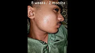 my minoxidil 5% journey