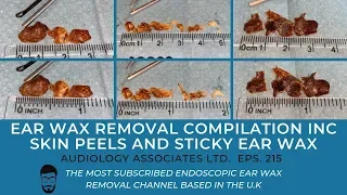 EAR WAX REMOVAL COMPILATION INC SKIN PEELS AND STICKY EAR WAX - EP 215