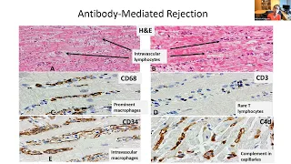 Approach to Antibodies in Heart Transplantation | Michelle Kittleson