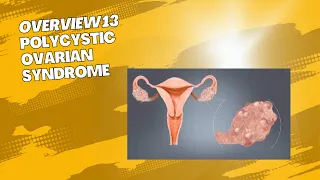 Overview 13 : Polycystic Ovarian Syndrome [PCOS]