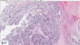 Kidney: Nephroblastoma (Wilms tumour) Microscopy - Talking slide