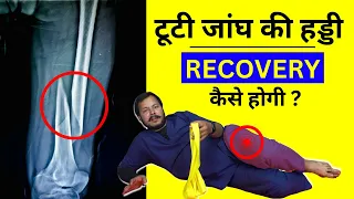 Femur Bone Fracture Exercises | Femur Bone Fracture Surgery Recovery - Physiotherapy Exercises