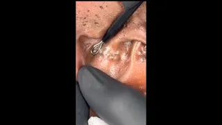 GIANTS Blackheads Removal From EAR (Blackheads Removal Videos 2023)
