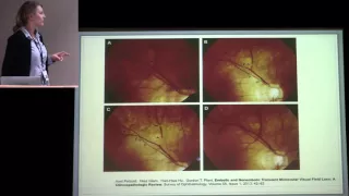 Transient Monocular Vision Loss