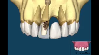 Bridge V/s Dental Implant