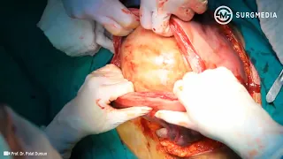 Ultimate Level: Minimizing blood loss at Cesarean Hysterectomy for Placenta Previa Percreta.