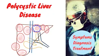 Polycystic Liver Disease | Symptoms, Diagnosis, Treatment