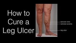 How To Cure A Leg Ulcer