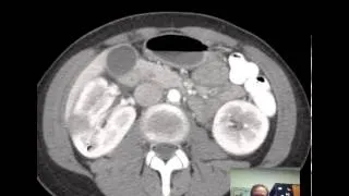 CT Kidneys and Bladder - Five pathologic cases discussed