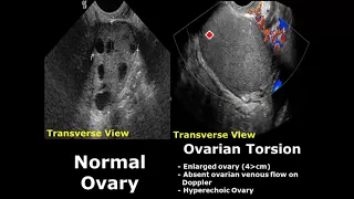 Ovary Ultrasound Normal Vs Abnormal Image Appearances | Ovarian Pathologies On USG