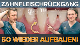 ZAHNFLEISCHRÜCKGANG ? Zahnfleisch wieder aufbauen mit Rezessionsdeckung! So funktioniert es ✅