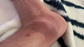 How To Heal A Bee Sting On Your Ankle That Is Swelling Really Bad (all better in less than 72 hours)