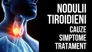 NODULII TIROIDIENI - cauze, simptome, tratament | dr. Ionut Sandu | Sănătate cu prioritate