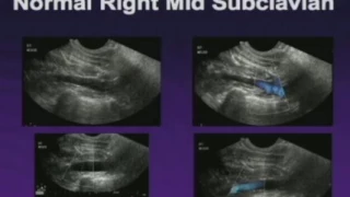 Upper Extremity Venous Exam Technique and Interpretation