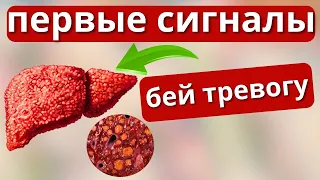 НЕ Игнорируй  ЭТИ  Признаки. Как распознать болезнь ПЕЧЕНИ на Ранних стадиях.