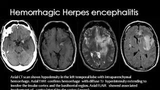 Imaging of Intracranial Infections   DRE 9   Dr Mamdouh Mahfouz