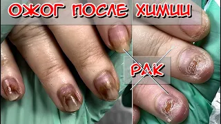 Nail burn after chemotherapy / Nails after cancer / Nails after chemistry