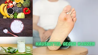 10 Natürliche Hausmittel gegen Warzen