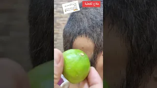 علاج الثعلبة بالليمون و الثوم الذكر او الثوم العادي الخلطة فعالة جدا