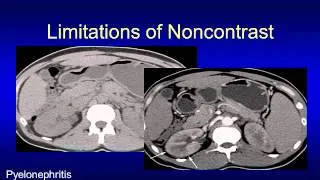 What am I missing on a noncontrast CT?