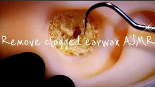 ASMR Ear cleaning to remove the earwax that clogs the ears *Rip off & Break earwax!* Rough & Intense