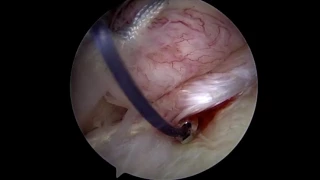 Arthroscopic 360 Degree Global Shoulder Stabilization