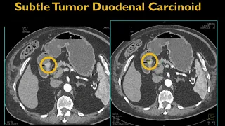 CT of the Small Bowel: Tumors Part 1