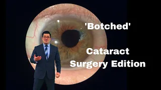 'Botched' Cataract Surgery Edition:  Iris Damage Repair