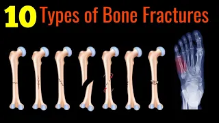 10 Most Common Bone Fractures|| Animated Explanations