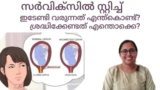 Short cervix during pregnancy malayalam /cerclage/cervix stitch malayalam #drchithra #pregnancytips