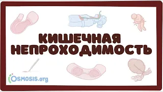 Острая кишечная непроходимость (хирургия лекция) Osmosis