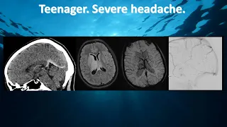 Teenager. Severe headache.