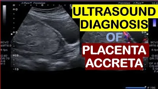 Ultrasound diagnosis of placenta accreta