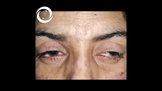 Ophthalmic Signs (Syndrome)