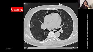 Approach to CT scan of the Acute Abdomen