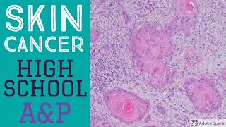 Skin Cancer for High School A&P Students