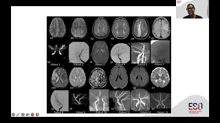 ESO Guideline Webinar on Moyamoya angiopathy & Tenecteplase for Acute Ischaemic Stroke