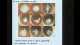 Innovations in Fungal Keratitis